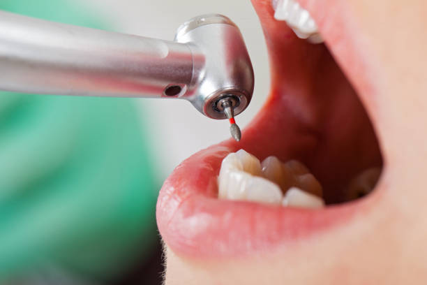 Best Emergency Root Canal Treatment in Santa Fe Springs, CA